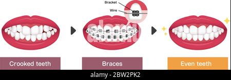 Zahnspangen Prozess Vektor Illustration Stock Vektor