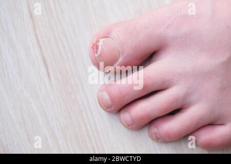 Weibchen roken Zehennagel von Beule auf Möbeln. Draufsicht. Stockfoto