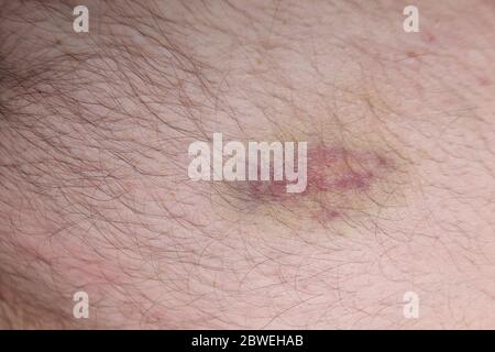 Blutergüsse auf der Haut Stockfoto