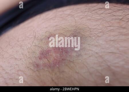 Blutergüsse auf der Haut Stockfoto