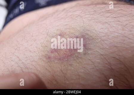 Blutergüsse auf der Haut Stockfoto