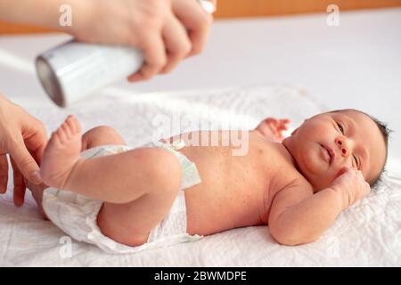 Mutter, die Thermalwasser auf die Haut des von Dermatitis betroffenen Neugeborenen gießt Stockfoto