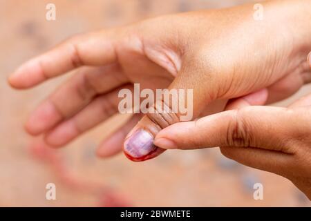 Verletzung des rechten Nagels und Blutung des rechten Daumens und Blutungen im Fingernagel Stockfoto