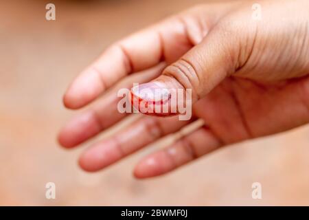 Verletzung des rechten Handnagels und Blutung am rechten Daumen und Blutung im Fingernagel Stockfoto