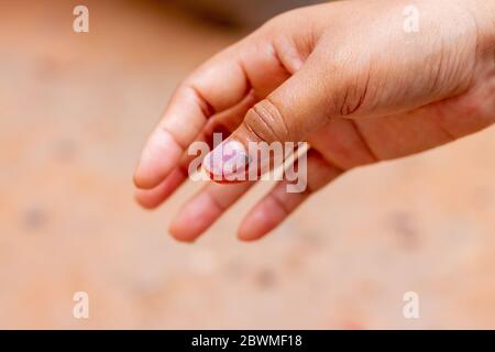 Verletzung des rechten Nagels und Blutung des rechten Daumens und Blutungen im Fingernagel Stockfoto