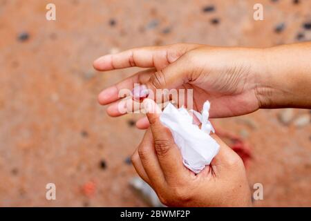 Verletzung des rechten Nagels und Blutung des rechten Daumens und Blutungen im Fingernagel Stockfoto