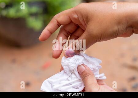 Verletzung des rechten Nagels und Blutung des rechten Daumens und Blutungen im Fingernagel Stockfoto