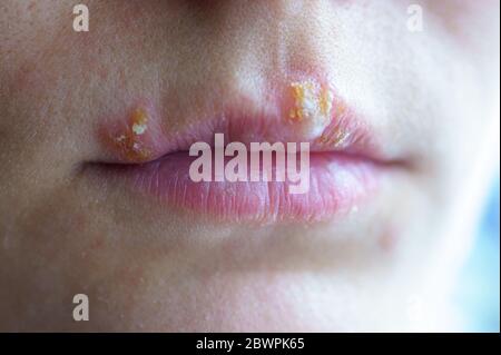 Herpes-Krankheit auf den Lippen eines jungen Mädchens. Wunden von Herpes auf den Lippen einer Person. Herpes foci. Stockfoto