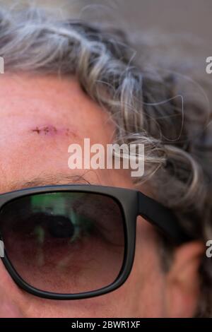 Nahaufnahme einer frischen Operationswunde mit Stichen, die eine Narbe auf der Stirn eines mannes zeigen. Älterer Mann trägt Sonnenbrille und grauendes lockiges Haar. Stockfoto