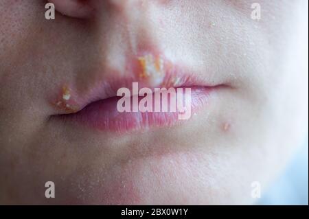 Herpes-Krankheit auf den Lippen eines jungen Mädchens. Wunden von Herpes auf den Lippen einer Person. Herpes foci. Stockfoto