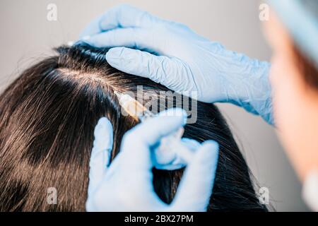 Plasmolifting der Kopfhaut - im Falle der Anfangsstadien der Haarausfall und zur Verbesserung des Zustands der Haare Stockfoto