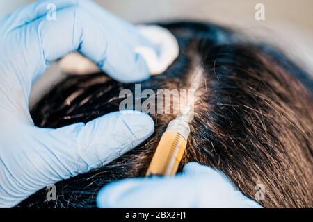 Injektion des Medikaments in die Kopfhaut unter der Kopfhaut - Stärkung der Haare und Verhinderung ihres Verlusts - selektive Fokussierung Stockfoto