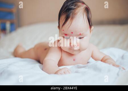 Mutter hält kleinen Jungen mit roten Pickel zu Hause. Chicken Pox Konzept varicella krank Baby Stockfoto