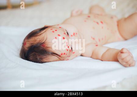 Kleines 5 Monate Baby mit Windpocken liegen schlecht zu Hause Stockfoto