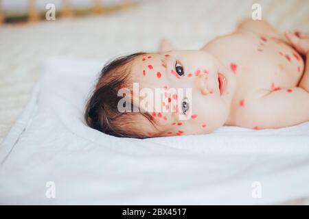 Kleines 5 Monate Baby mit Windpocken liegen schlecht zu Hause Stockfoto