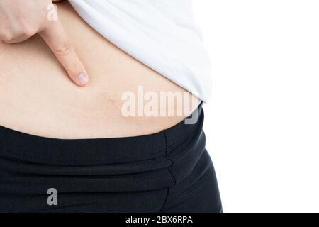 Nahaufnahme der Frau, die Narbe auf ihrem Bauch zeigt, die auf weißem Hintergrund isoliert ist. Gesundheitswesen und medizinisches Konzept. Stockfoto