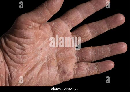 Ekzem mit Rötungen, Schwellungen, Beulen und Flocken an Hand und Fingern eines Mannes. Isoliert auf Schwarz Stockfoto