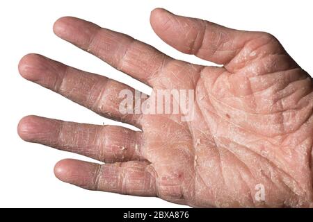 Ekzem mit Rötungen, Schwellungen, Beulen und Flocken an Hand und Fingern eines Mannes, verursacht durch Sonne, Atopie oder Kontaktallergene. Isoliert auf Weiß Stockfoto