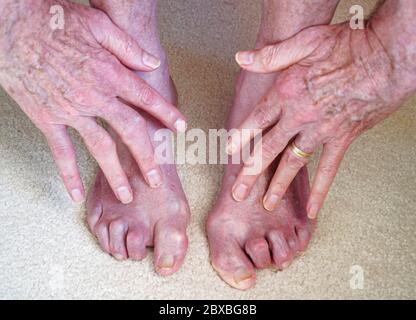 Finger und Zehen des 73-jährigen Mannes mit rheumatoider Arthritis seit 35 Jahren. Stockfoto