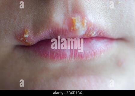 Herpes-Krankheit auf den Lippen eines jungen Mädchens. Wunden von Herpes auf den Lippen einer Person. Herpes foci. Stockfoto