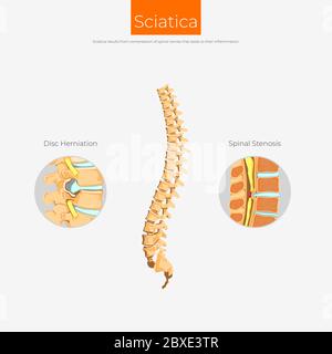Ischias resultiert aus Kompression der Spinalnerven Stock Vektor