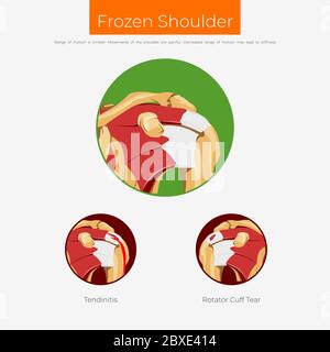 Poster zum anatomischen Schema der gefrorenen Schulter Stock Vektor