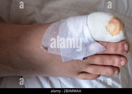 Laura hat einen Zehennagel entfernt und einen nach drei erfolglosen Versuchen, eingewachsende Zehennagel gelöst. Die Operation dauerte 2 Stunden. Stockfoto