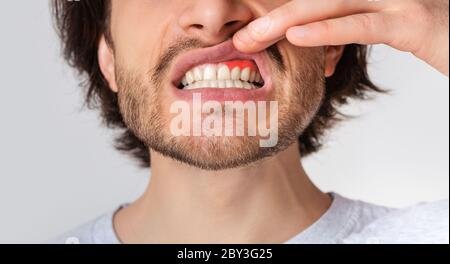 Zahnfleischentzündung und Zahnprobleme. Guy drückt seine Lippe nach oben und zeigt roten Gummi Stockfoto