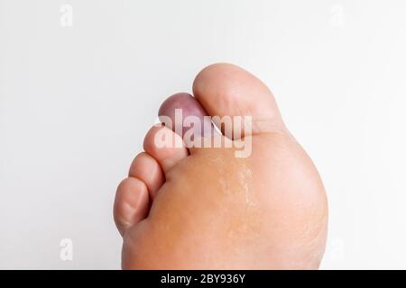 Gequetscht Zehen, Rechter Fuß Stockfoto