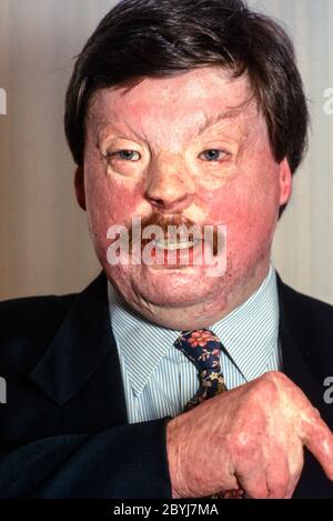 Simon Weston Wohltätigkeitsarbeiter Veteran der britischen Armee, die schwere Verbrennungen im Falklandkrieg erlitten Stockfoto