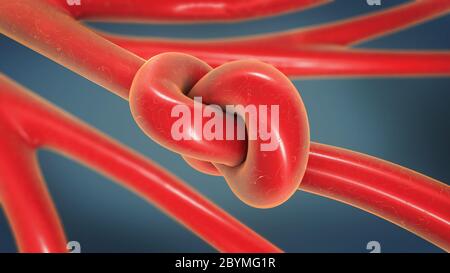 3D-Darstellung eines Knoten in einer Arterie verengt wird und verengten Arteriosklerose genannt Stockfoto