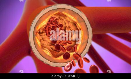 3D-Darstellung eines ausgefällt und Verengung der Blutgefäße oder Arteriosklerose Stockfoto