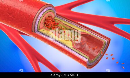 3D-Darstellung eines ausgefällt und Verengung der Blutgefäße oder Arteriosklerose Stockfoto