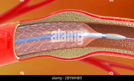 3D-Darstellung der stentimplantation zur Unterstützung der Durchblutung in den Blutgefäßen Stockfoto