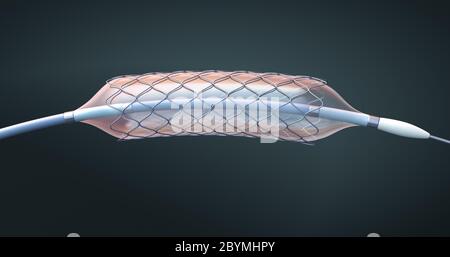 Stent und Katheter zur Implantation und Unterstützung der Durchblutung in Blutgefäße - 3d-Illustration Stockfoto