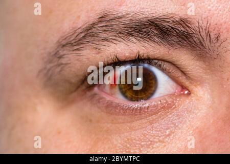 Augenverletzungen, junger Mann mit Platzen von Blutgefäßen im Auge, Ermüdung, Probleme mit den Blutgefäßen Stockfoto