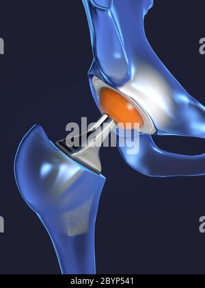 Funktion eines Hüftgelenkimplantats oder einer Hüftprothese in der Frontalansicht - 3d-Illustration Stockfoto