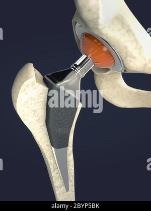 Funktion eines Hüftgelenkimplantats oder einer Hüftprothese in der Frontalansicht - 3d-Illustration Stockfoto