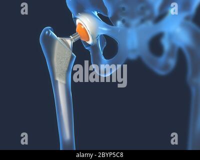 Funktion eines Hüftgelenkimplantats oder einer Hüftprothese in der Frontalansicht - 3d-Illustration Stockfoto