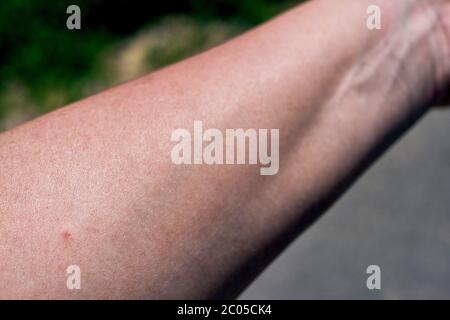 Zeckenstich auf dem Arm einer Frau. Kleiner roter Punkt, Hautrötung, Wunde und Folgen direkt nach dem Insektenstich. Dokumentiert an einem sonnigen Frühlingstag. Stockfoto