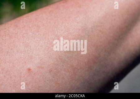 Zeckenstich auf dem Arm einer Frau. Kleiner roter Punkt, Hautrötung, Wunde und Folgen direkt nach dem Insektenstich. Dokumentiert an einem sonnigen Frühlingstag. Stockfoto