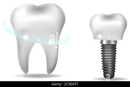 Zahnimplantate, Prothetik 3D realistischer Stil. Zahnmedizin, gesundes Zahnkonzept. Vektorgrafik Stock Vektor