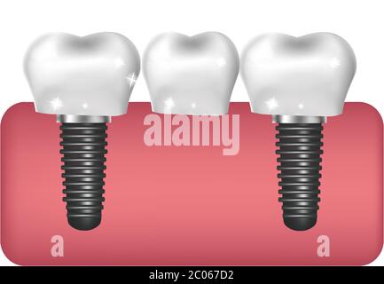 Zahnimplantate, Brückenbau, Prothetik 3D realistischer Stil. Zahnmedizin, gesundes Zahnkonzept. Vektorgrafik Stock Vektor