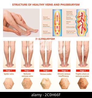 Thrombophlebitis. Thrombose Der Tiefen Vene. Krampfadern. Phlebeurysm. Struktur der normalen Venen und ungesunden Vene Stockfoto