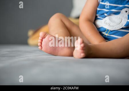 Kinder Füße, stechen durch eine Biene, Sommerzeit Stockfoto