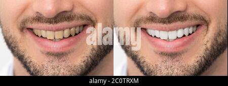 Zähne vor und nach dem Aufhellen. Zahnärztliche Versorgung Konzept Stockfoto