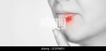 Mädchen mit Herpes. Symptom "krank". Lippen kalt Stockfoto