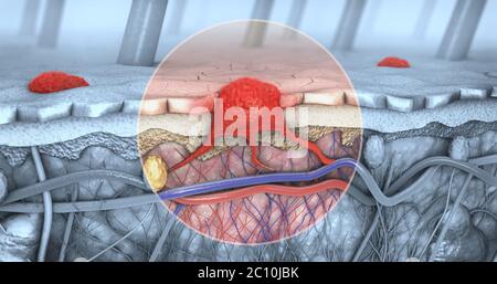 3D-Darstellung der Querschnitt einer kranke Haut mit Melanomen, die in die Blutbahn und lymphatische Trakt Stockfoto