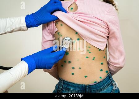 Arzt, der ein Kind mit Stethoskop untersucht, das mit grünen Ausschlägen auf dem Rücken bedeckt ist, der an Windpocken, Masern oder Röteln erkrankt ist. Stockfoto