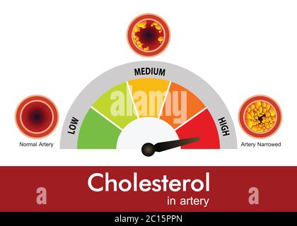 Cholesterin in der Arterie, Gesundheitsrisiko, Vektor-Design Stock Vektor